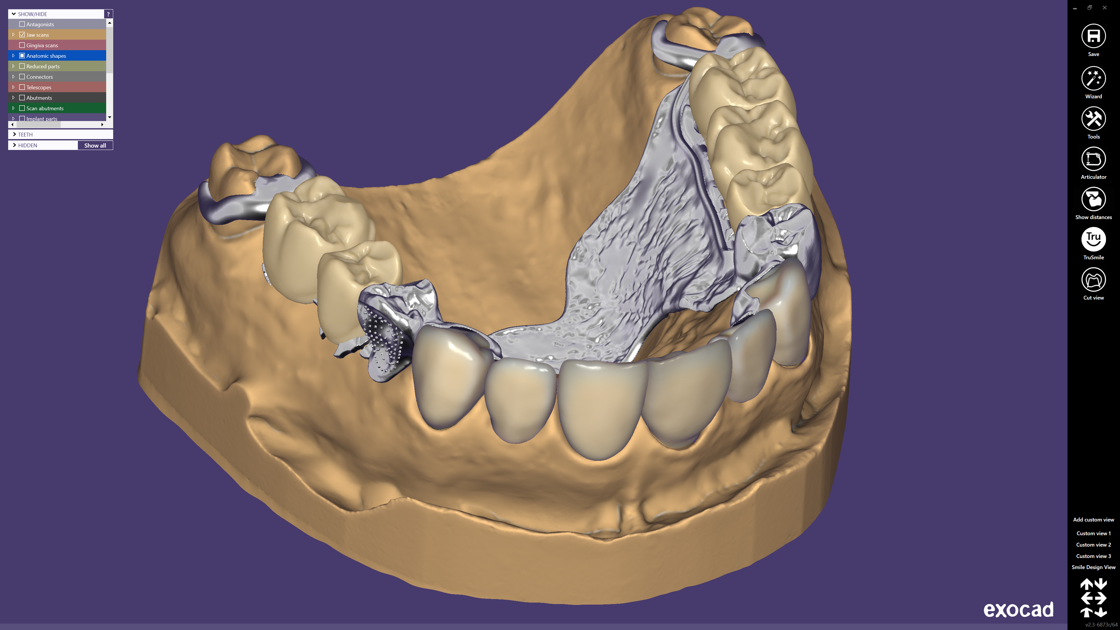 Тотальная d. CAD/cam моделирование exocad. Exocad моделирование зубов. CAD cam стоматология exocad. Моделировка балки в exocad.