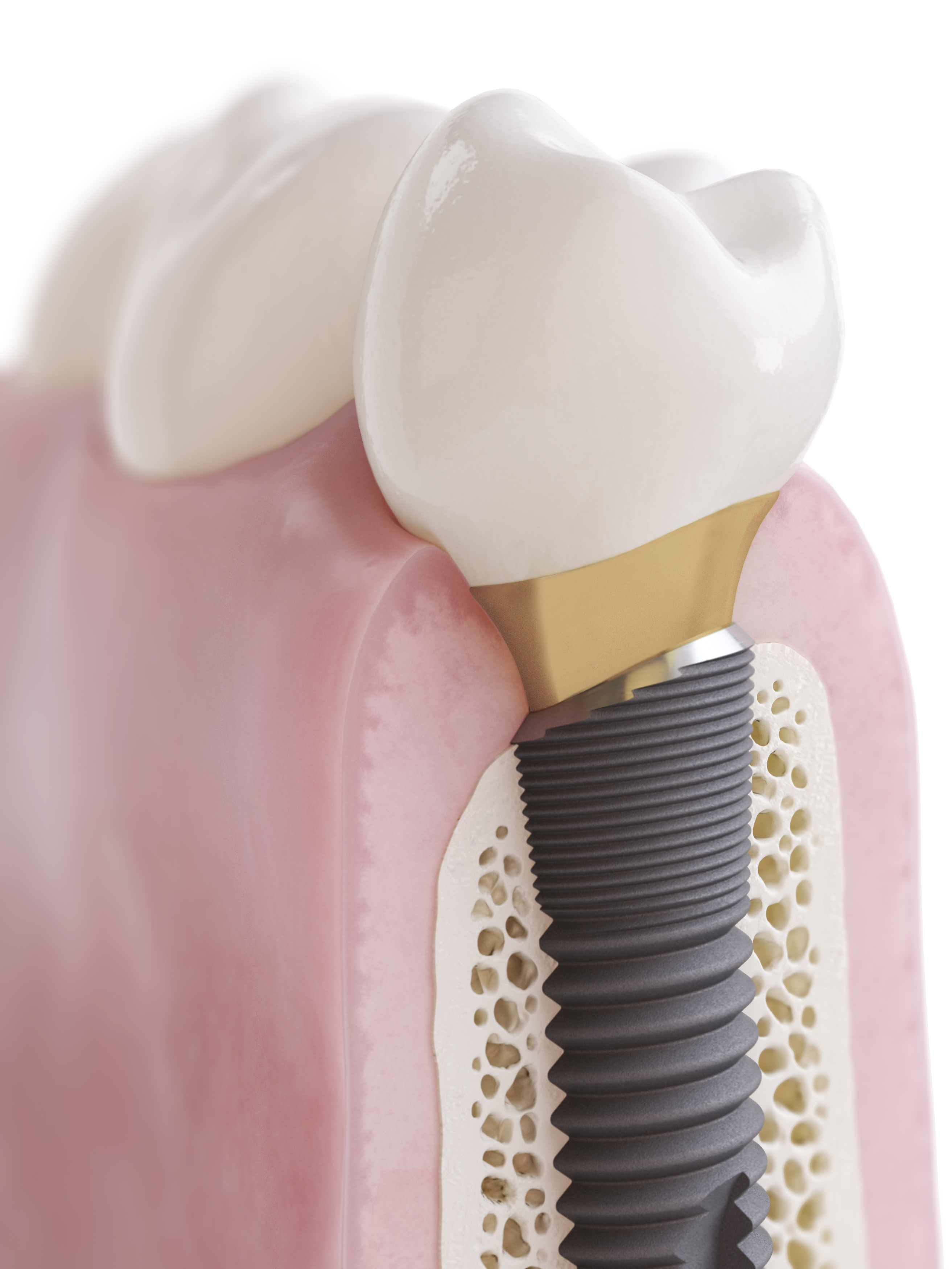 Supporting The Full Implant Treatment Process – From Planning To Final ...